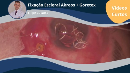 Fixação Escleral em 4 pontos com Goretex