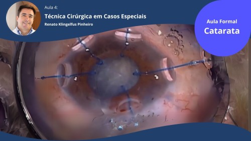 Catarata 4 - Tecnica Cirúrgica Especial